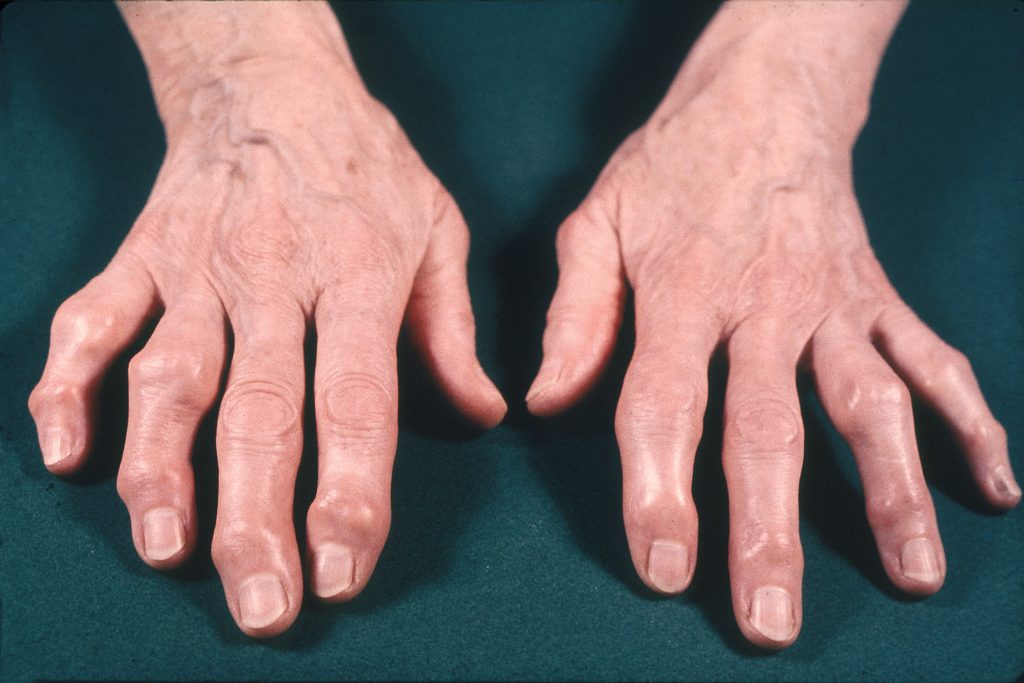 Artritis en los dedos delas manos