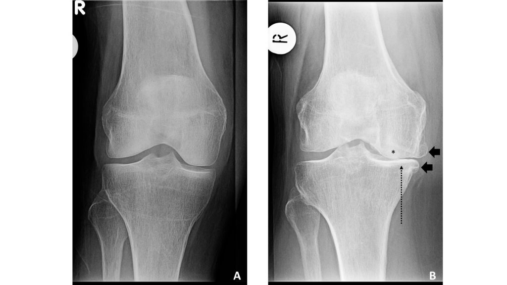Sample e-ray images from the Johnston County Osteoarthritis Project showing a healthy knee and a knee with osteoarthritis